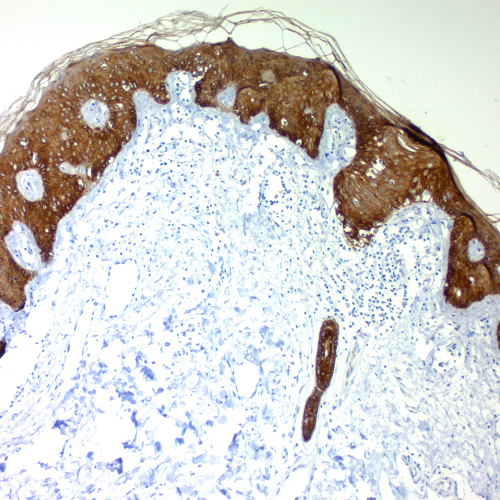 Cytokeratin, Multi (Acidic); Clone AE1 (Concentrate)